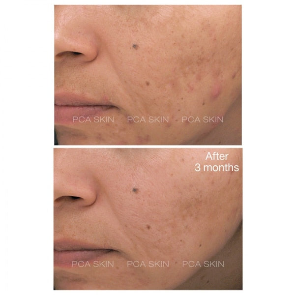 Blemish Control Bar PCA